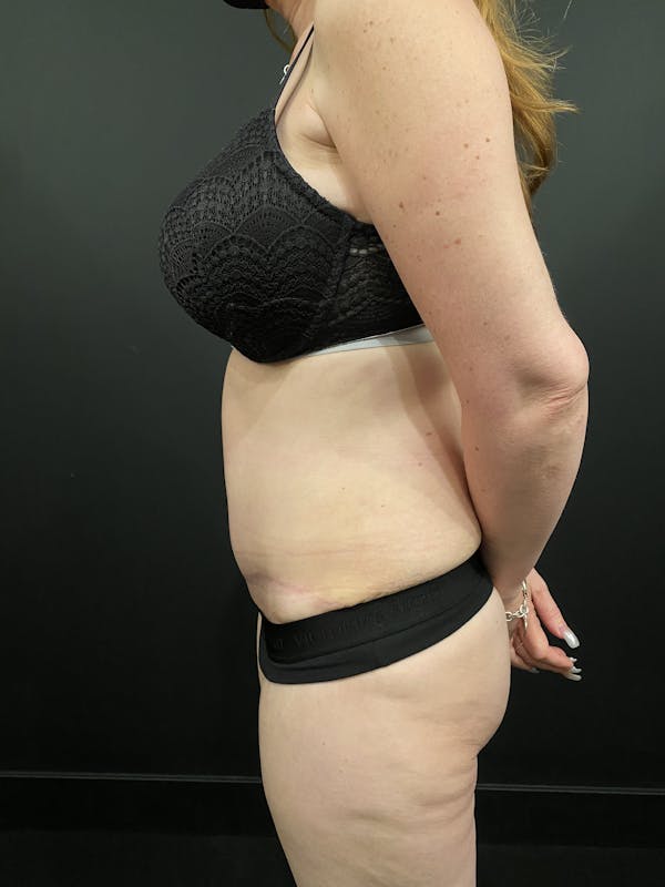 Tummy Tuck Before & After Gallery - Patient 20536490 - Image 6