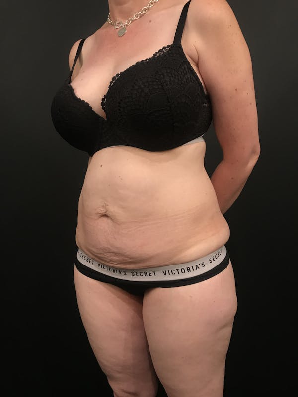 Tummy Tuck Before & After Gallery - Patient 20536490 - Image 1