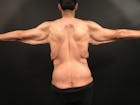 Arm Lift Before & After Gallery - Patient 20542675 - Image 1