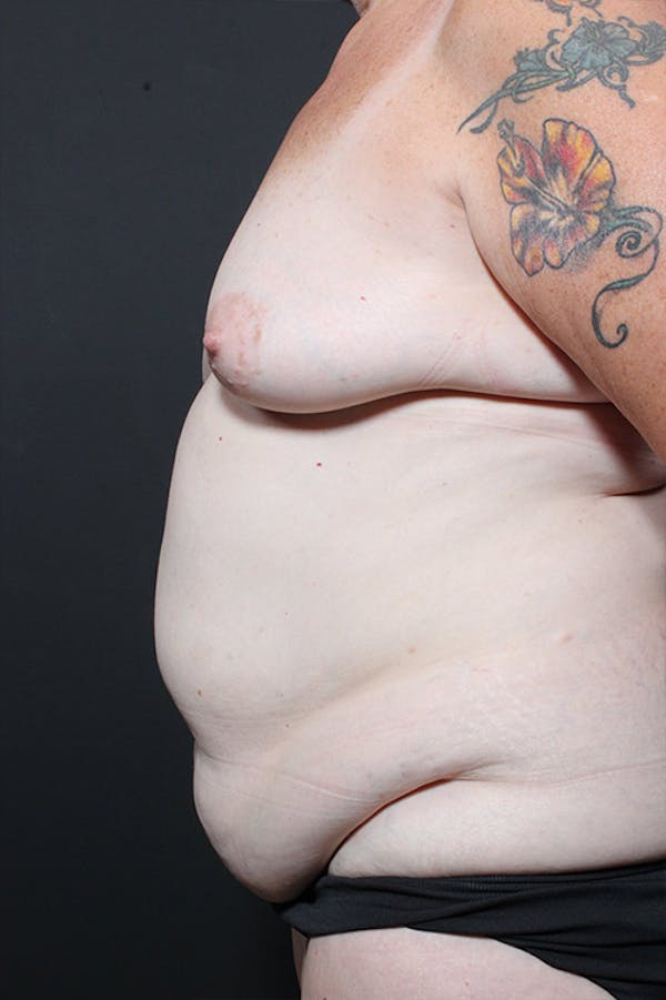 Tummy Tuck Before & After Gallery - Patient 20543185 - Image 5