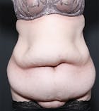 Tummy Tuck Before & After Gallery - Patient 20543186 - Image 1