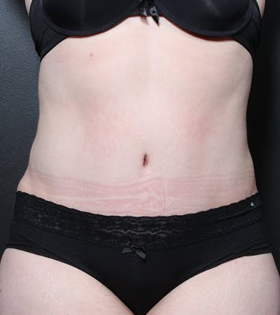 Tummy Tuck Before & After Gallery - Patient 20543197 - Image 2
