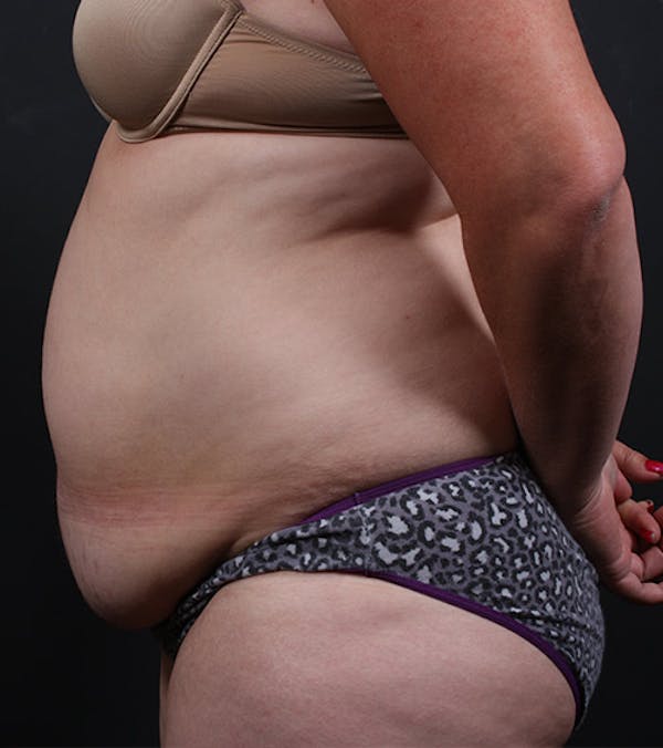 Tummy Tuck Before & After Gallery - Patient 20543197 - Image 5