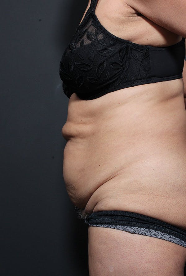 Tummy Tuck Before & After Gallery - Patient 20543199 - Image 5