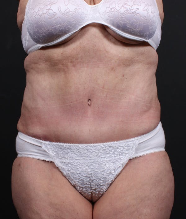 Tummy Tuck Before & After Gallery - Patient 20543222 - Image 2
