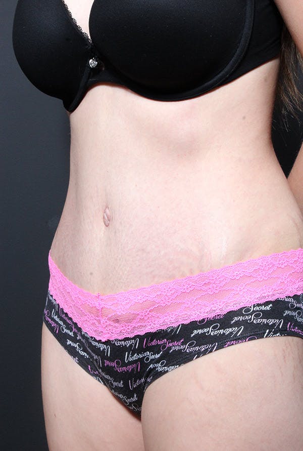 Tummy Tuck Before & After Gallery - Patient 20543223 - Image 4