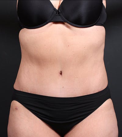 Tummy Tuck Before & After Gallery - Patient 20543234 - Image 2