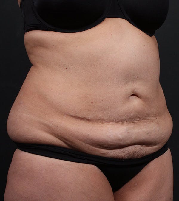Tummy Tuck Before & After Gallery - Patient 20543234 - Image 3