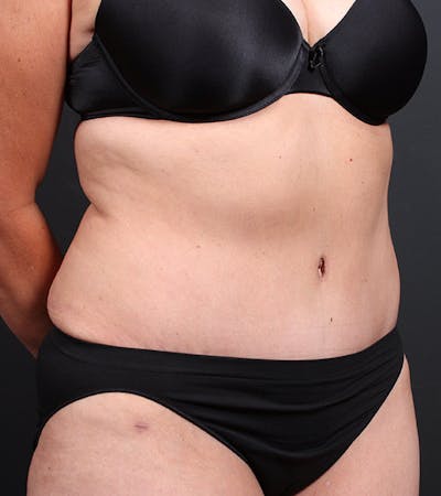 Tummy Tuck Before & After Gallery - Patient 20543234 - Image 4