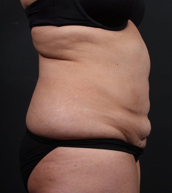 Tummy Tuck Before & After Gallery - Patient 20543234 - Image 5