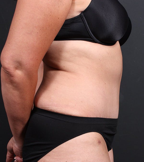 Tummy Tuck Before & After Gallery - Patient 20543234 - Image 6