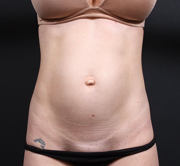 Tummy Tuck Before & After Gallery - Patient 20543244 - Image 1