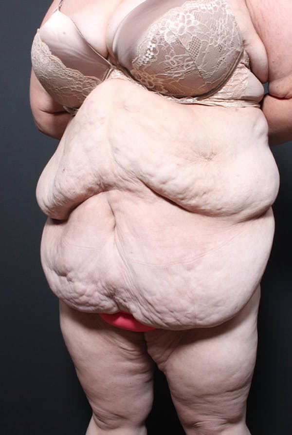Tummy Tuck Before & After Gallery - Patient 20543248 - Image 3