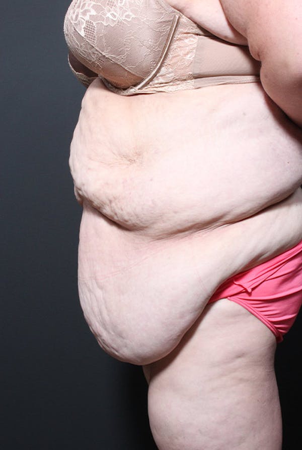 Tummy Tuck Before & After Gallery - Patient 20543248 - Image 5