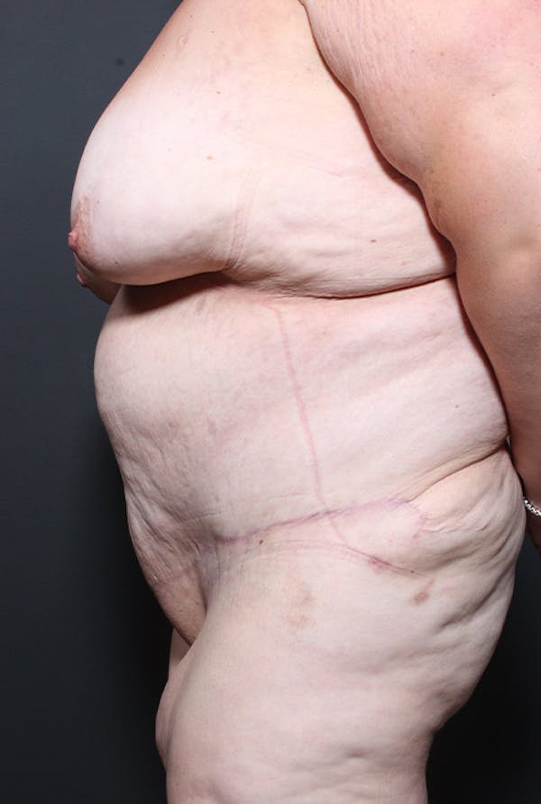 Tummy Tuck Before & After Gallery - Patient 20543248 - Image 6