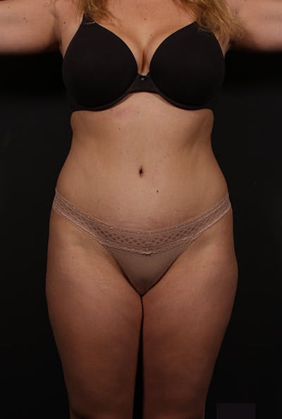 Tummy Tuck Before & After Gallery - Patient 20543249 - Image 1