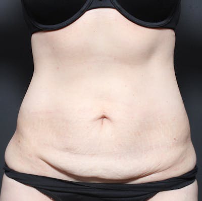 Tummy Tuck Before & After Gallery - Patient 20543250 - Image 1