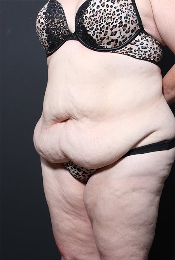 Tummy Tuck Before & After Gallery - Patient 20543251 - Image 3