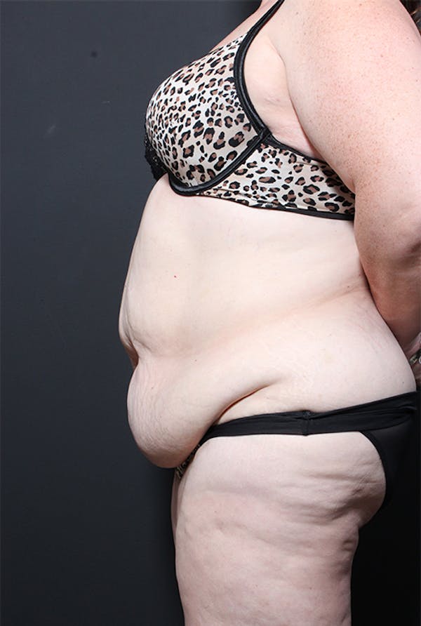 Tummy Tuck Before & After Gallery - Patient 20543251 - Image 5