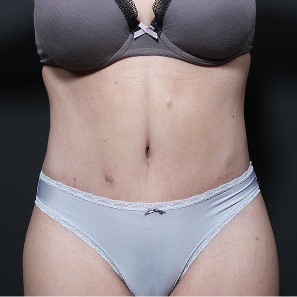 Tummy Tuck Before & After Gallery - Patient 20543256 - Image 2