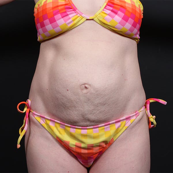 Tummy Tuck Before & After Gallery - Patient 20543258 - Image 1
