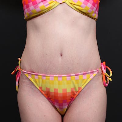 Tummy Tuck Before & After Gallery - Patient 20543258 - Image 2