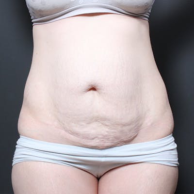 Tummy Tuck Before & After Gallery - Patient 20543260 - Image 1