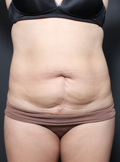 Tummy Tuck Before & After Gallery - Patient 20543261 - Image 1