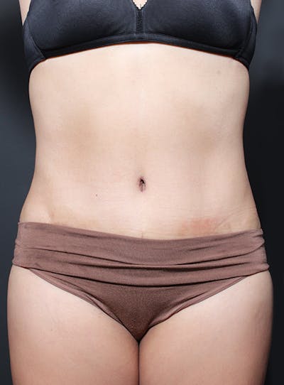 Tummy Tuck Before & After Gallery - Patient 20543261 - Image 2