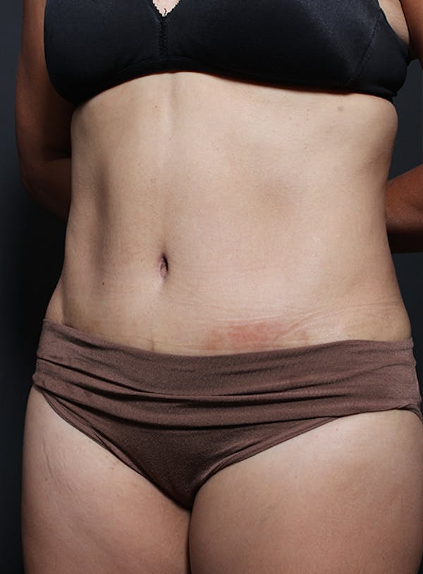 Tummy Tuck Before & After Gallery - Patient 20543261 - Image 4