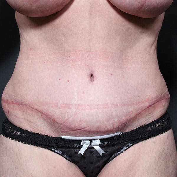 Tummy Tuck Before & After Gallery - Patient 20543270 - Image 2