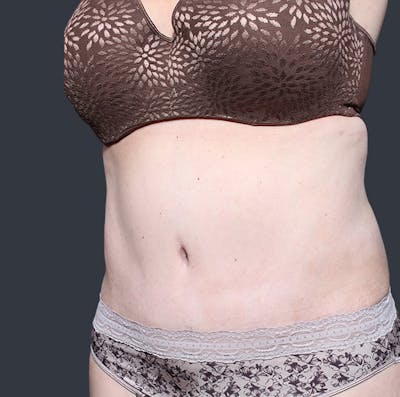 Tummy Tuck Before & After Gallery - Patient 20543280 - Image 4