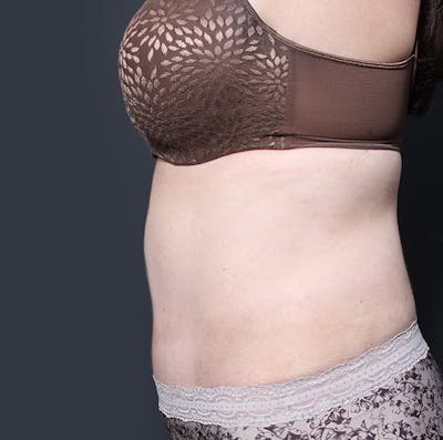 Tummy Tuck Before & After Gallery - Patient 20543280 - Image 6