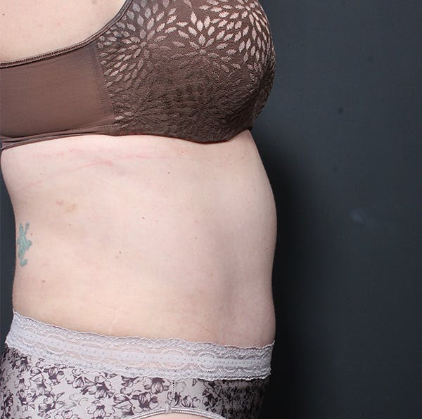 Tummy Tuck Before & After Gallery - Patient 20543280 - Image 10