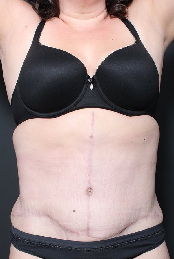 Tummy Tuck Before & After Gallery - Patient 20543282 - Image 2