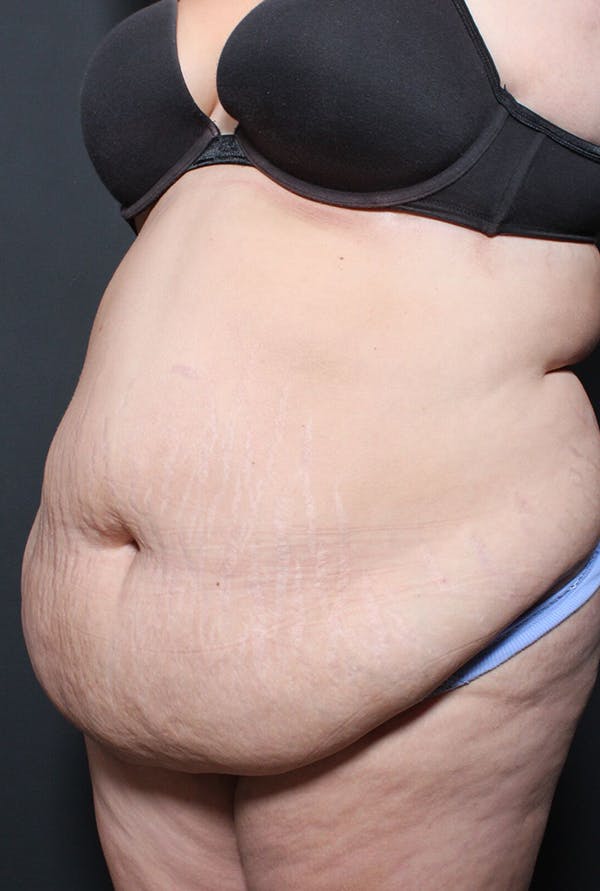 Tummy Tuck Before & After Gallery - Patient 20543285 - Image 3