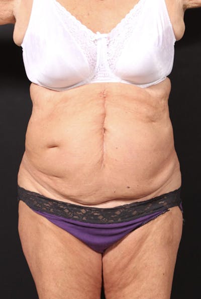 Tummy Tuck Before & After Gallery - Patient 20543291 - Image 1