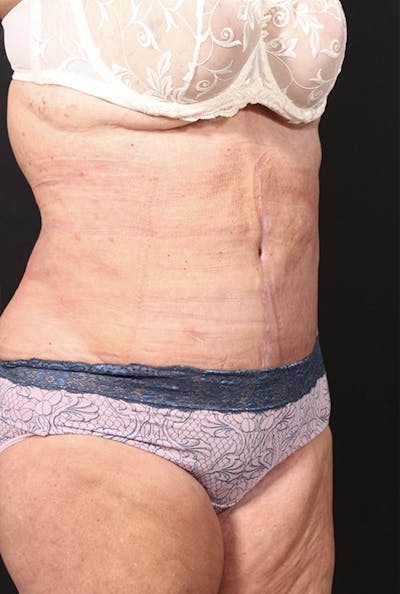 Tummy Tuck Before & After Gallery - Patient 20543291 - Image 4