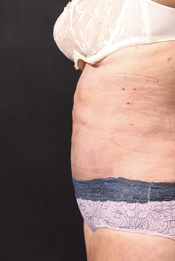 Tummy Tuck Before & After Gallery - Patient 20543291 - Image 8