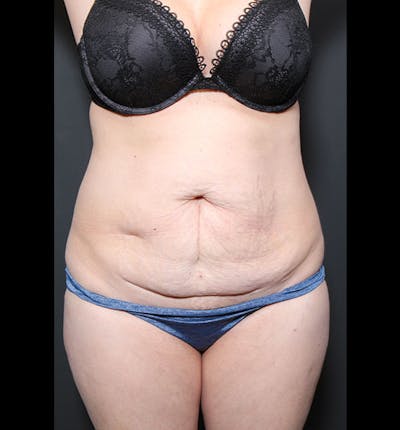 Tummy Tuck Before & After Gallery - Patient 20543299 - Image 1
