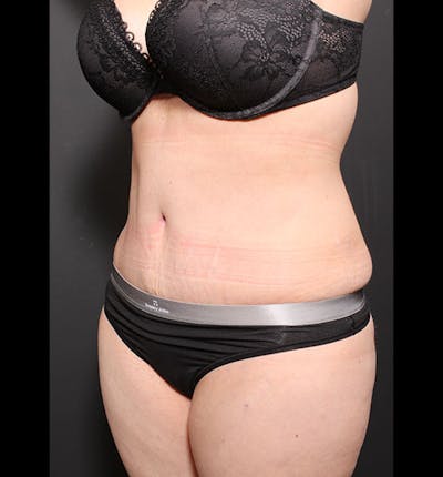 Tummy Tuck Before & After Gallery - Patient 20543299 - Image 4