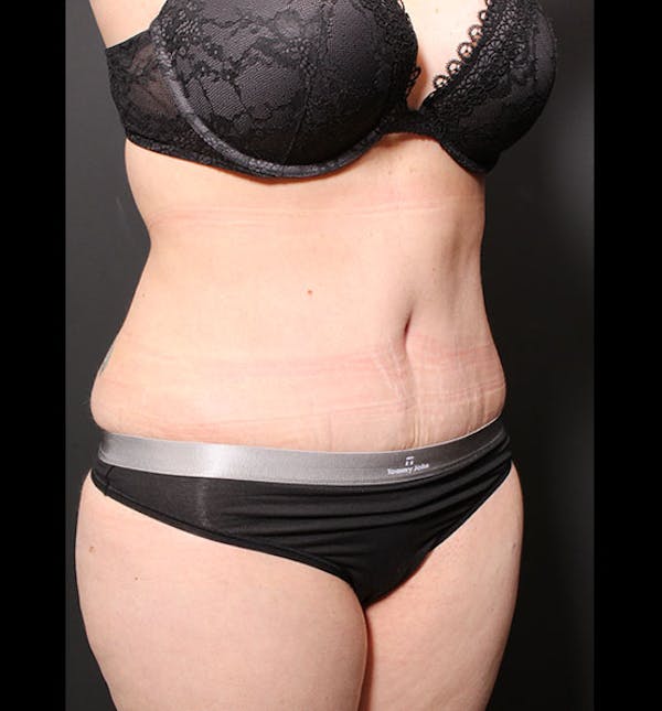 Tummy Tuck Gallery - Patient 20543299 - Image 8