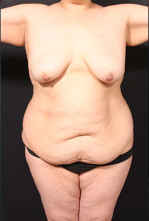 Tummy Tuck Before & After Gallery - Patient 20543300 - Image 1