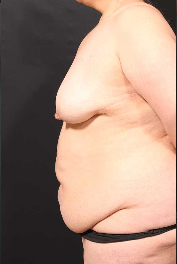 Tummy Tuck Before & After Gallery - Patient 20543300 - Image 5