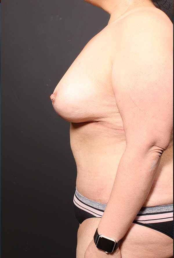 Tummy Tuck Before & After Gallery - Patient 20543300 - Image 6