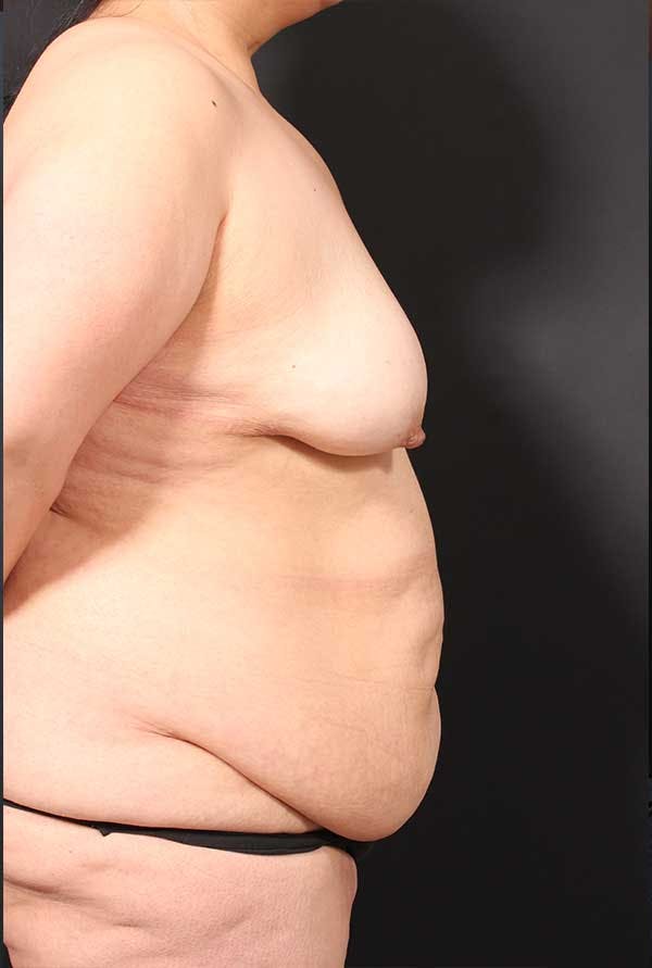 Tummy Tuck Before & After Gallery - Patient 20543300 - Image 9