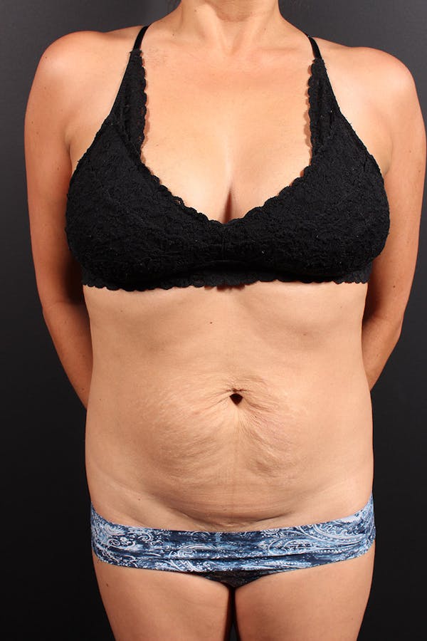 Tummy Tuck Before & After Gallery - Patient 20543301 - Image 1