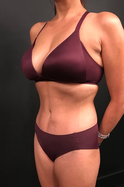 Tummy Tuck Before & After Gallery - Patient 20543301 - Image 4