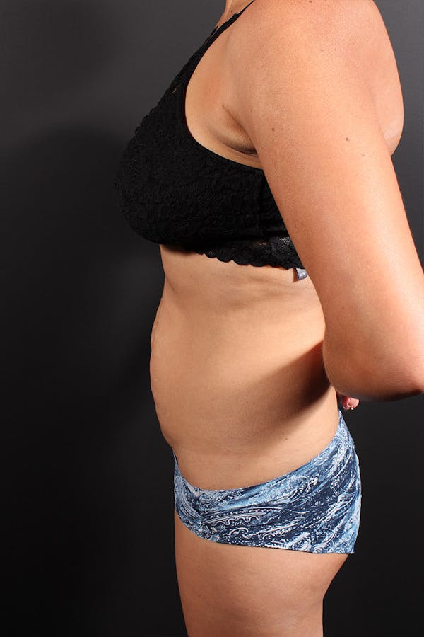 Tummy Tuck Before & After Gallery - Patient 20543301 - Image 5