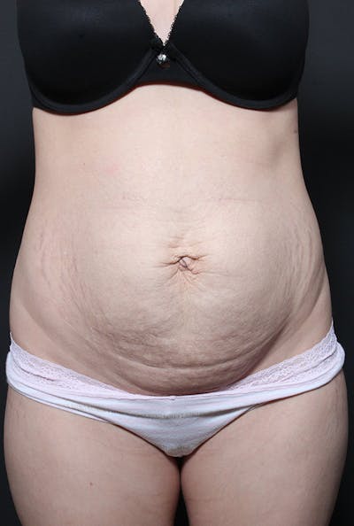 Tummy Tuck Before & After Gallery - Patient 20543303 - Image 1